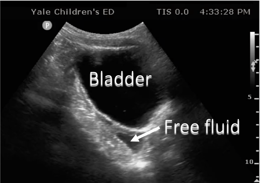 annotated pelvic ultrasound