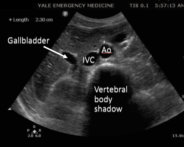 aorta and IVC ultrasound image