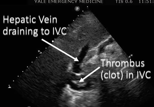 ivc pathology ultrasound image