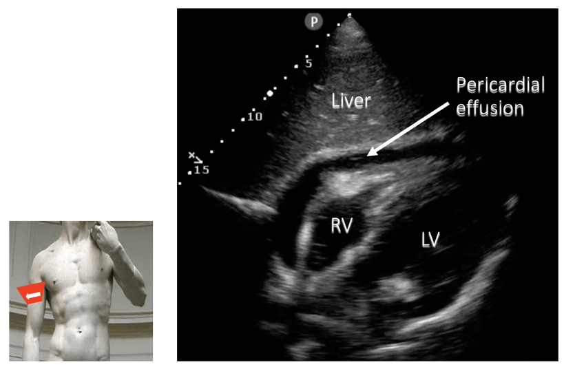 pericardial fluid ultrasound annotated image