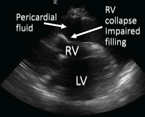 pericardiocentesis ultrasound image