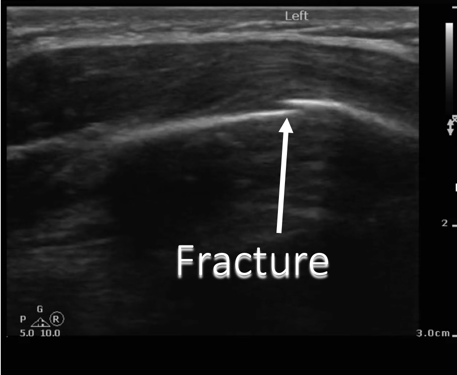 rib fracture ultrasound image