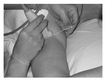 sensor position ultrasound guided nerve block