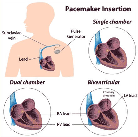 pacemaker illustration