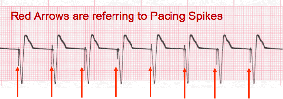 pacemaker rhythm ECG tracing