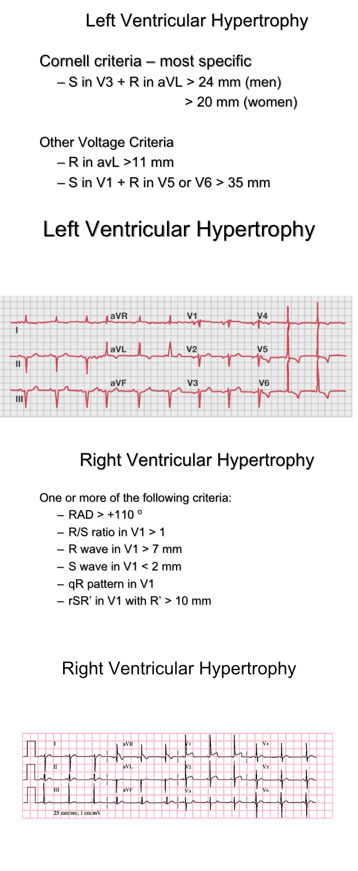 ventricular hypertrophy