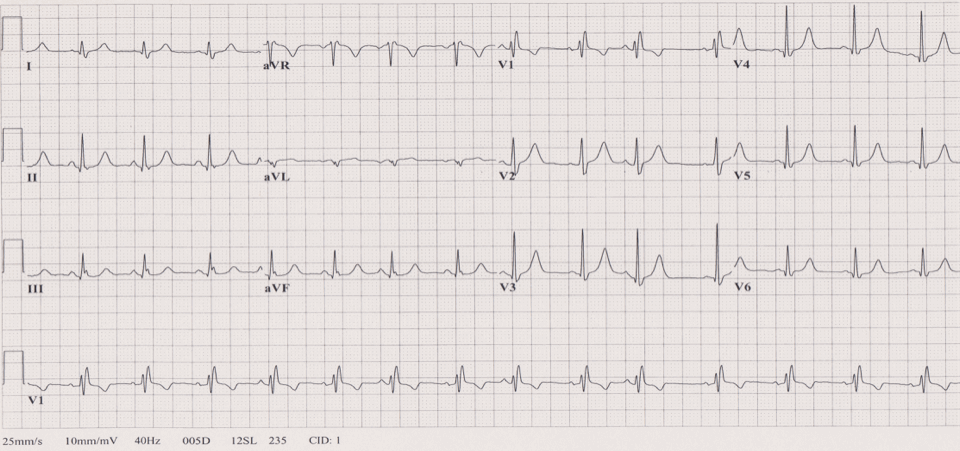 12 lead ecg for coaching