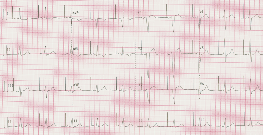 12 lead ecg for coaching