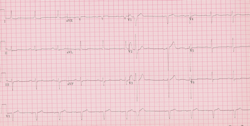 12 lead ecg for coaching