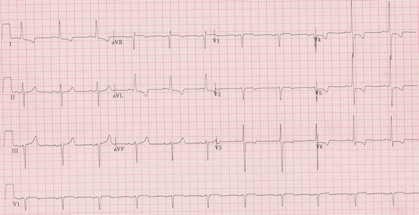 12 lead ecg for coaching