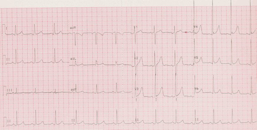 12 lead ecg for coaching