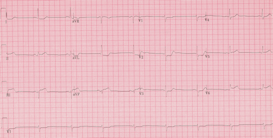 12 lead ecg for coaching