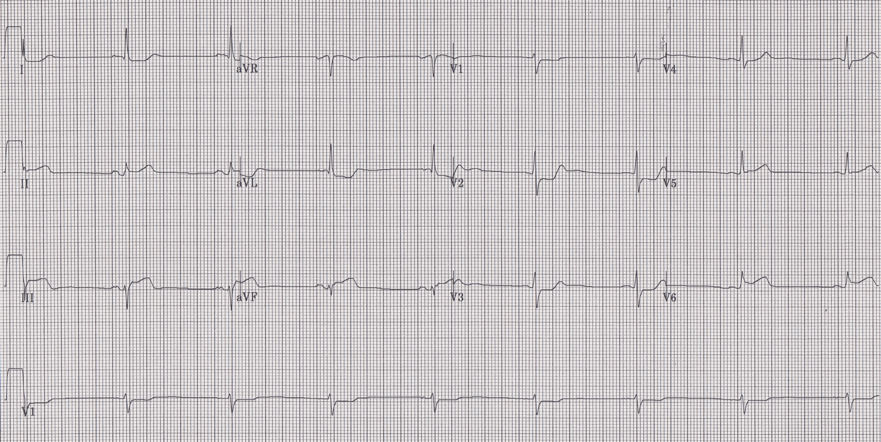 12 lead ecg for coaching