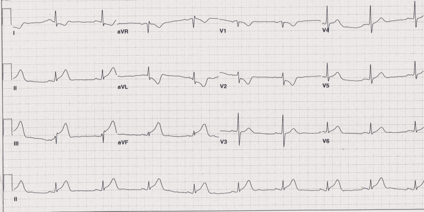 12 lead ecg for coaching