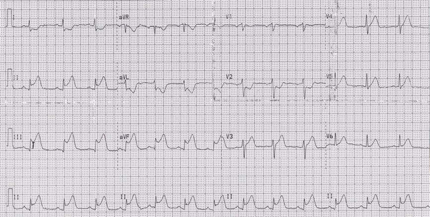 12 lead ecg for coaching