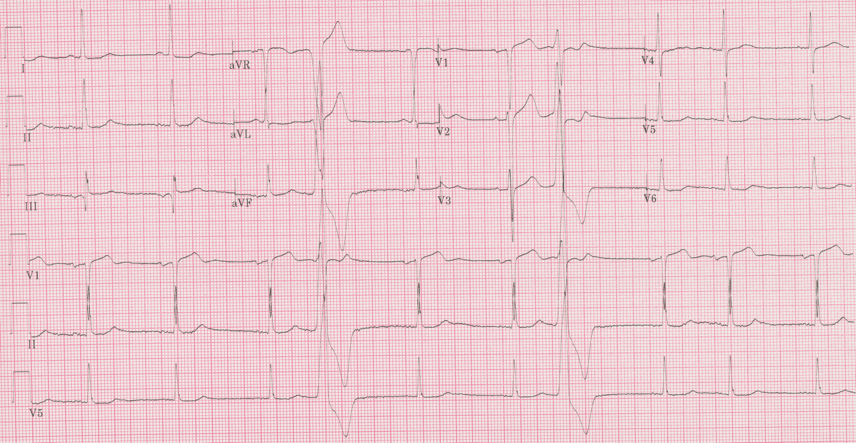 12 lead ecg for coaching