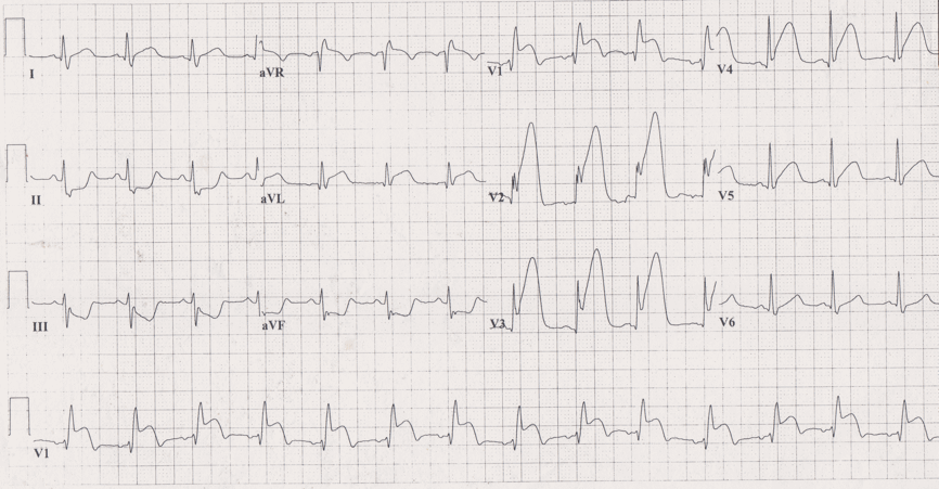 12 lead ecg for coaching