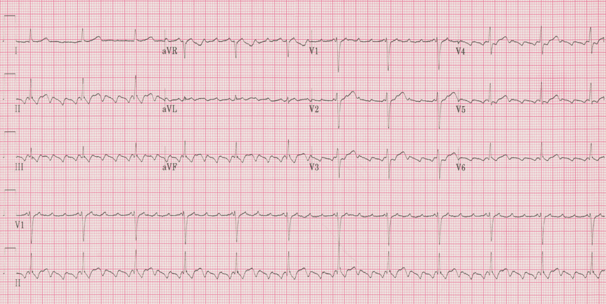 12 lead ecg for coaching