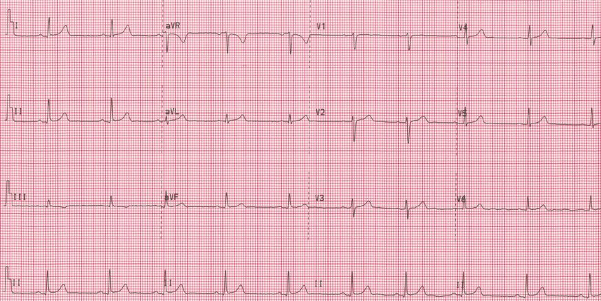 12 lead ecg for coaching