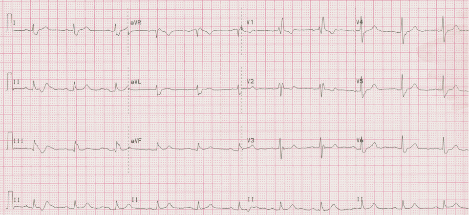 12 lead ecg for coaching