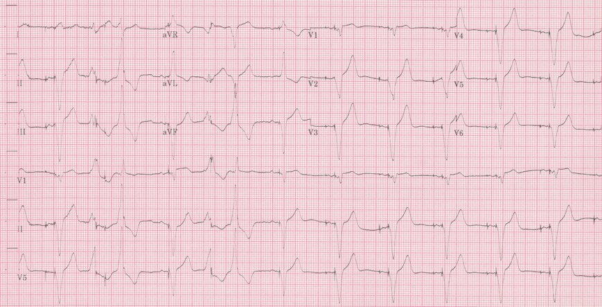 12 lead ecg for coaching