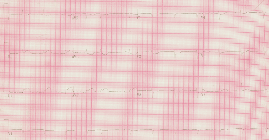 EKG 12 Lead Analysis and Interpretation Practice Quiz