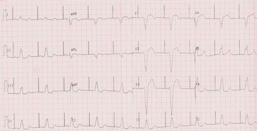 12 lead ecg for coaching