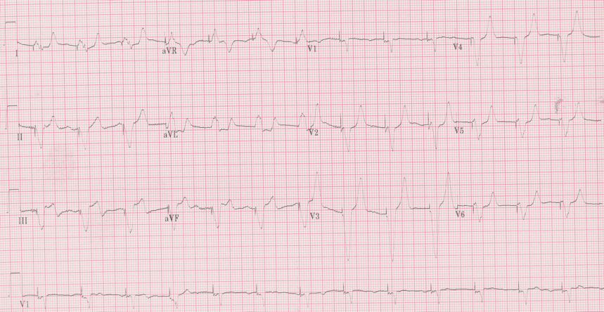 12 lead ecg for coaching