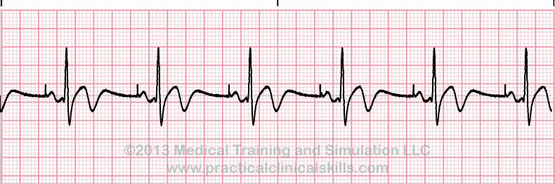 Normal Single Chamber Pacemaker ECG tracing