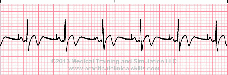 Pacemaker Single Chamber Atrial ECG Interpretation with Sample Strip