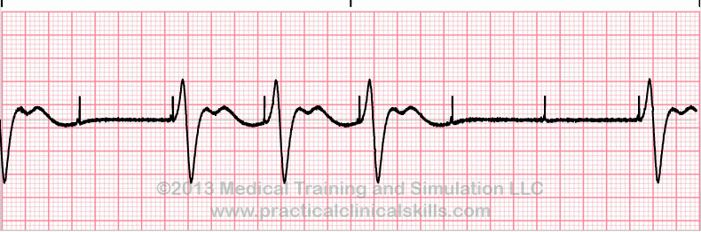 Failure to Capture EKG tracing