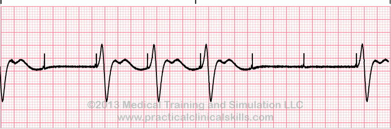 Failure to Capture ECG tracing