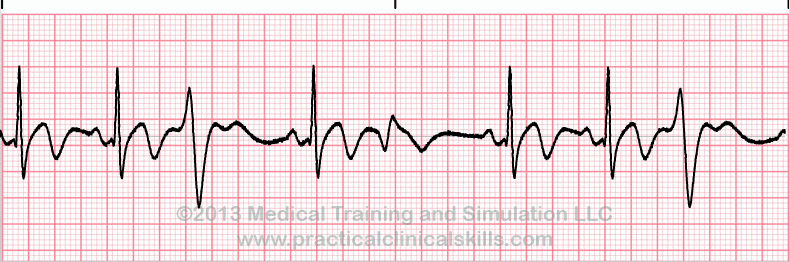 ecg rhythm strip for quiz