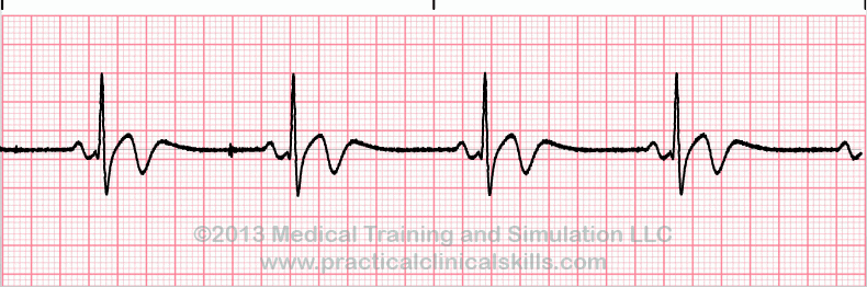 Sinus Bradycardia EKG tracing