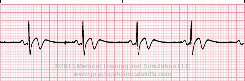 Sinus Bradycardia ECG tracing