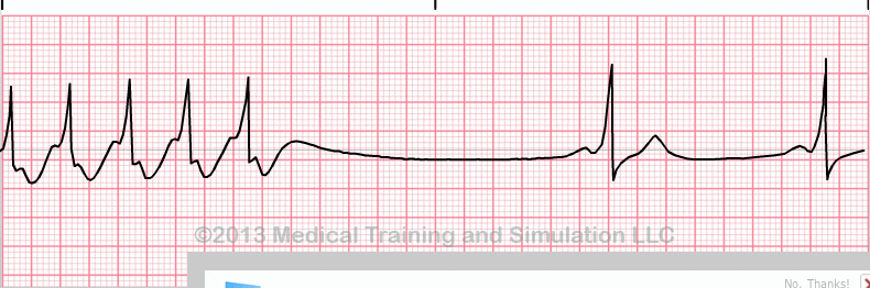 ecg rhythm strip for reference guide