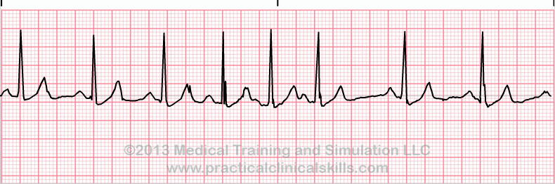 ecg rhythm strip for quiz