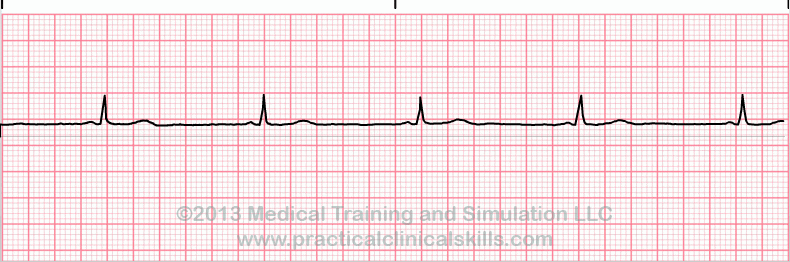 ecg rhythm strip for quiz