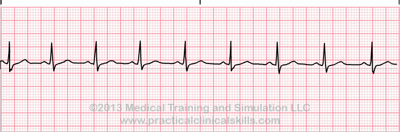 ecg rhythm strip for quiz