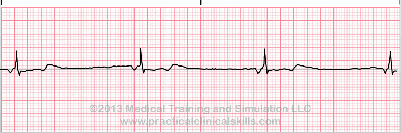 Junctional Escape rhythm EKG tracing