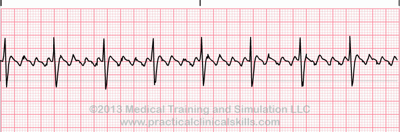 ecg rhythm strip for quiz