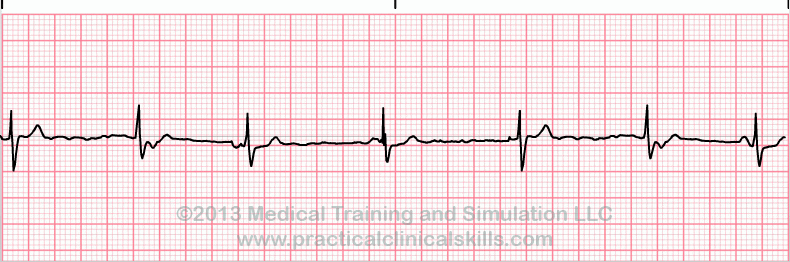 ekg rhythm strip for reference guide