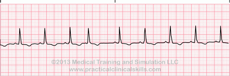 ecg rhythm strip for reference guide