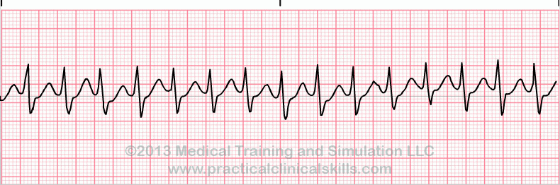 ecg rhythm strip for quiz