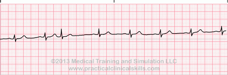 ecg rhythm strip for quiz