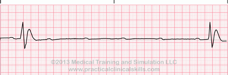Third Degree Heart Block EKG tracing