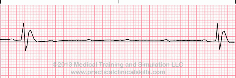 ecg rhythm strip for reference guide