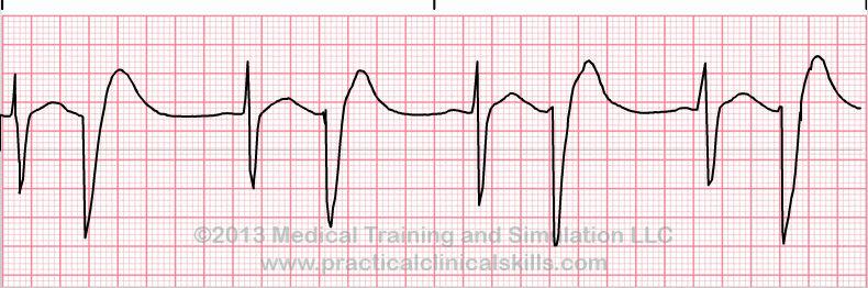 ECG Practice Drill