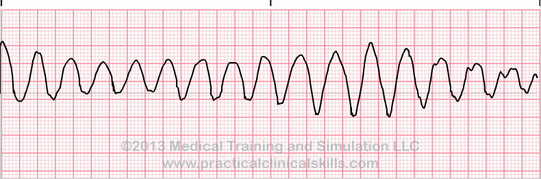 Ventricular Tachycardia Polymorphic EKG tracing