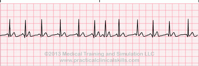 Multifocal Atrial Tachycardia ECG tracing